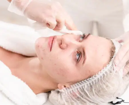 Eine junge Frau lässt ihre Aknenarben professionell behandeln